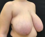 Breast Reduction