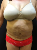 Tummy Tuck