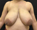 Breast Reduction