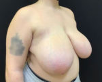 Breast Reduction