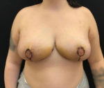 Breast Reduction