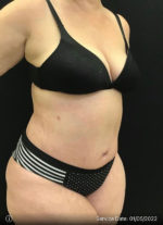 Tummy Tuck