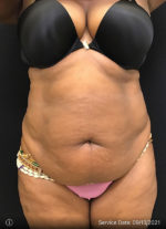 Liposuction