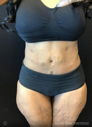 Liposuction