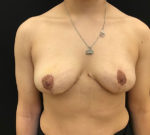 Breast Lift