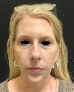 Botox Cosmetic and Dysport