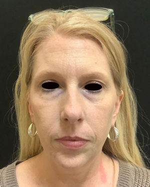 Botox Cosmetic and Dysport