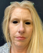 Botox Cosmetic and Dysport