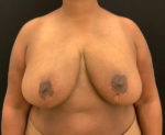 Breast Reduction