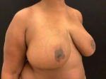Breast Reduction
