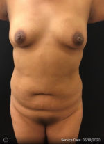 Breast Augmentation