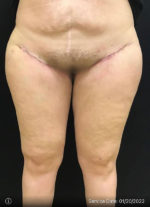 Thigh Lift