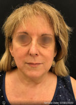 Facelift