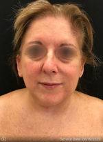 Facelift