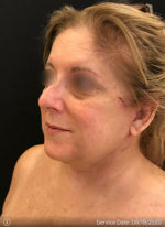 Facelift