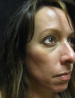 Botox Cosmetic and Dysport