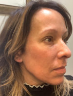Botox Cosmetic and Dysport