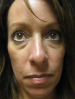 Botox Cosmetic and Dysport