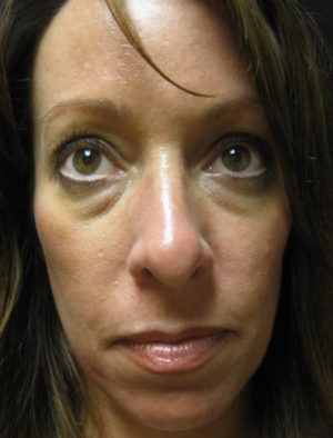 Botox Cosmetic and Dysport