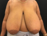 Breast Reduction