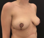 Breast Reduction
