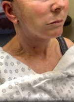 Facelift
