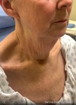 Facelift