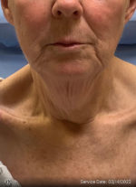 Facelift