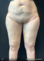 Thigh Lift