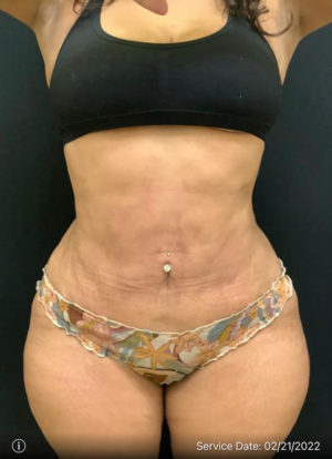 Liposuction