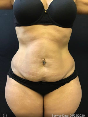 Liposuction