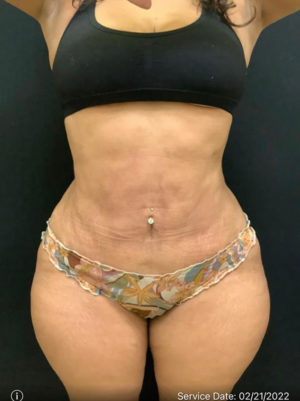 Liposuction