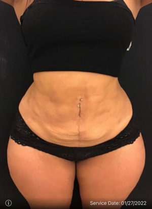 Liposuction