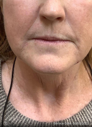 Around The Mouth Fillers