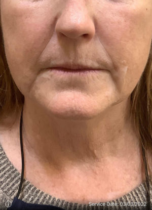 Around The Mouth Fillers