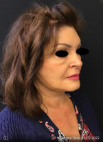 Facelift