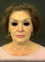 Facelift