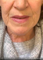 Around The Mouth Fillers