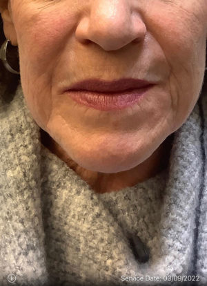 Around The Mouth Fillers