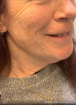 Around The Mouth Fillers