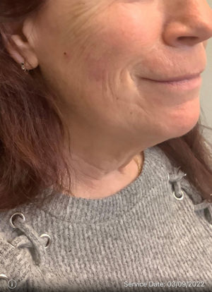 Around The Mouth Fillers