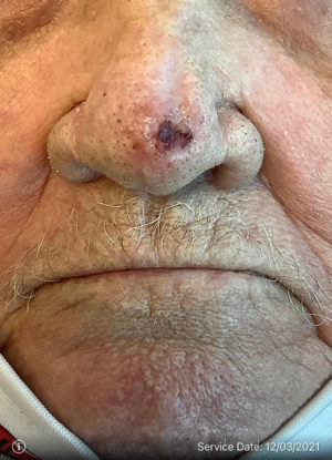 Basal Cell Carcinoma