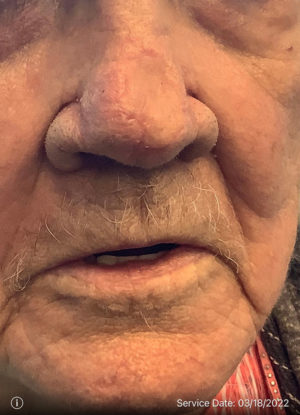 Basal Cell Carcinoma