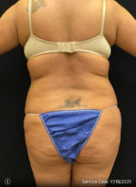 Liposuction