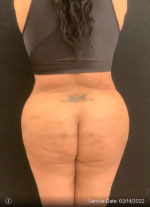 Liposuction