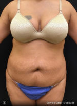 Liposuction