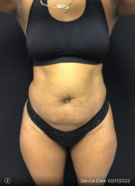 Liposuction