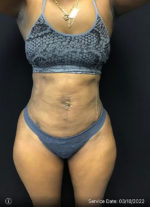 Liposuction