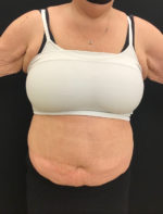 Tummy Tuck