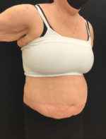 Tummy Tuck